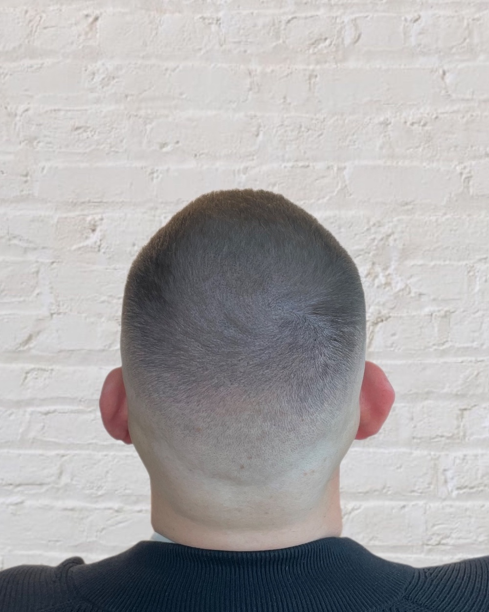Nachher: nach Haartransplantation