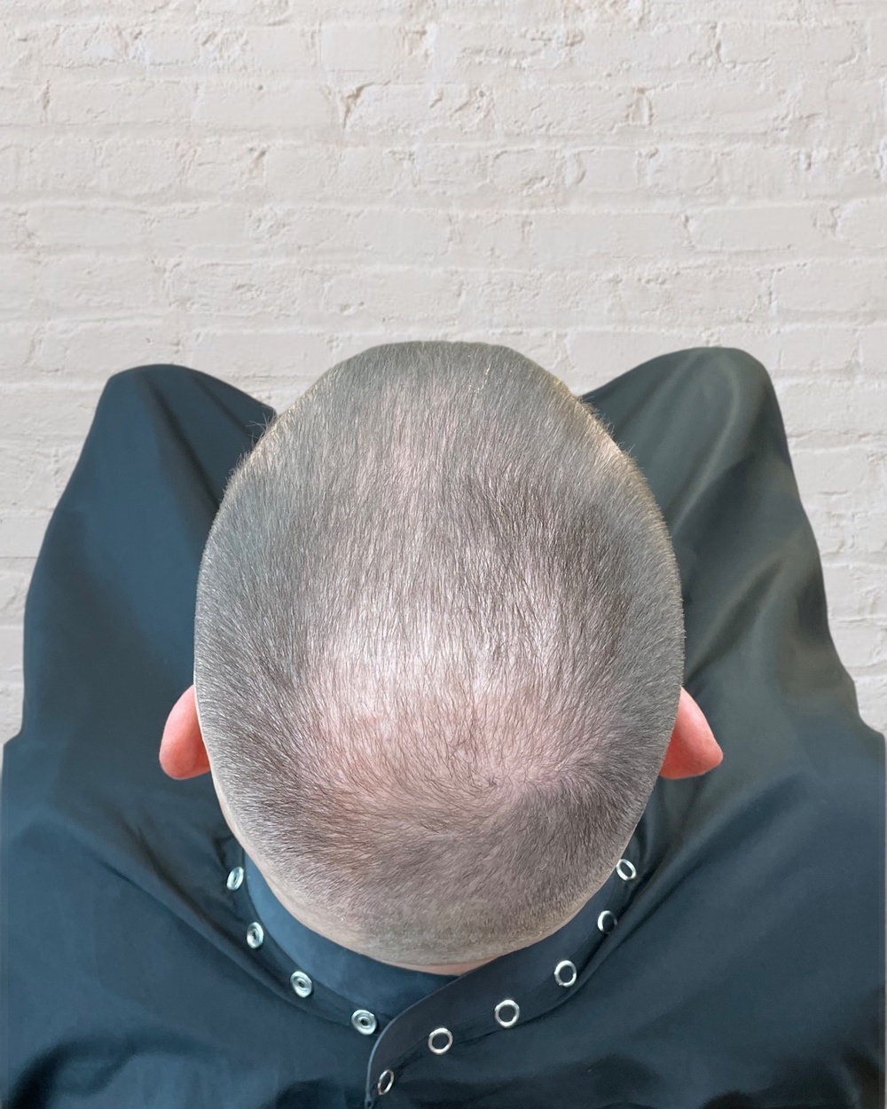 Vorher: nach Haartransplantation